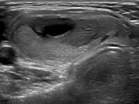 Modified K-TIRADS 3 nodule with partially cystic US pattern in a... | Download Scientific Diagram