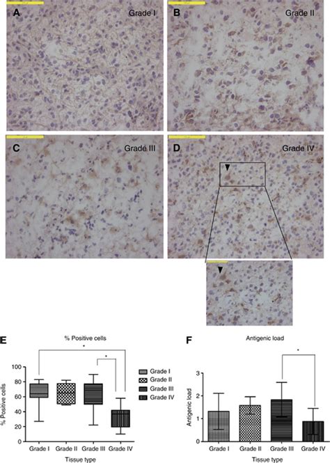 Specimens Of Human Astrocytoma Grades Iiv Immunohistochemically