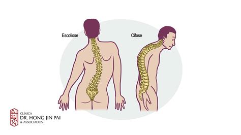 Cifose corcunda na coluna O que é causas sintomas e tratamentos