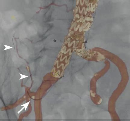 Image Demonstrating Merging Of Fluoroscopy And Computed Tomography