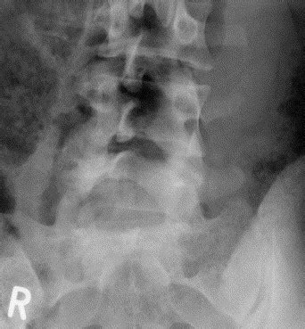 Traumatic Unilateral Facet Dislocation Of The Lumbosacral Junction Injury