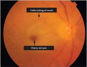 Differential DIagnosis of Cherry Red Spot - Medical Zone