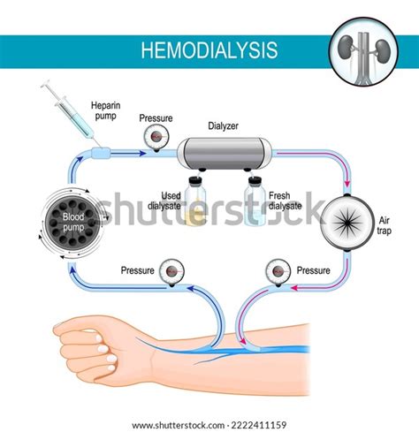 혈액투석기의 원리 투석 과정 혈액투석은 혈액을 스톡 벡터 로열티 프리 2222411159 Shutterstock