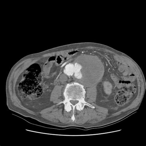 Penetrating Atheromatous Ulcer | Aorta