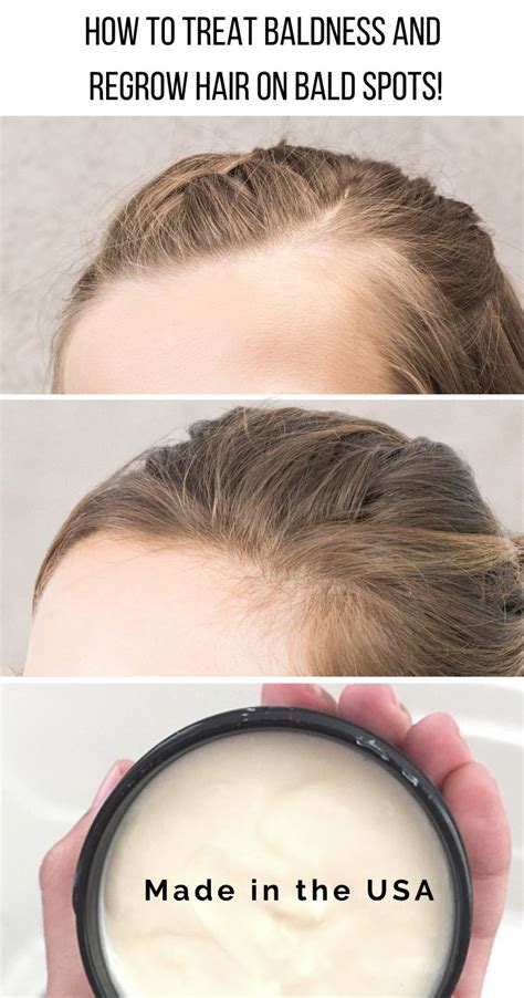 How To Regrow Hair On Bald Spot Fast Tips And Tricks The Definitive