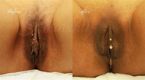 Labiaplasty Gallery Heavenly Plastic Surgery