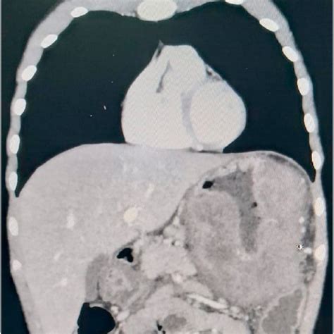 Cect Showing Thickening Of The Stomach Download Scientific Diagram