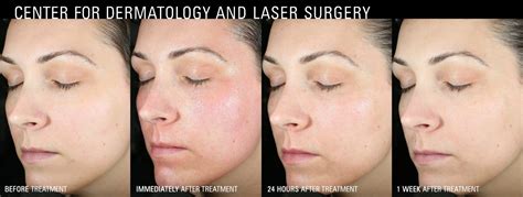 Tetra Co2 Coolpeel Sacramento Ca Emil A Tanghetti Md