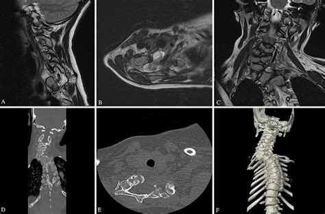 Preoperative Mri And Ct A Sagittal T2 Weighted Mri Shows An Anterior