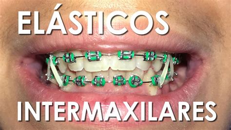 El Sticos Conoce Los Tipos De El Sticos Intermaxilares Youtube