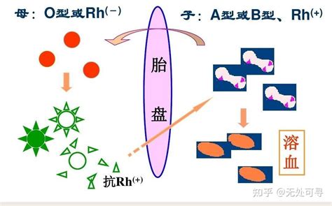 新生儿溶血儿科学第九版第六章做PPT可用提炼 知乎