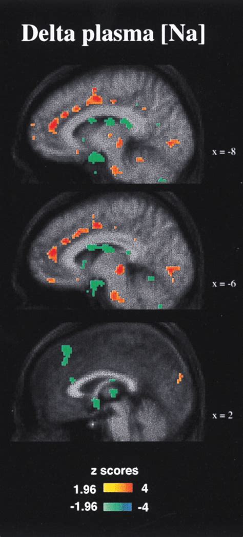 The Correlation Of Regional Cerebral Blood Flow And The Change In