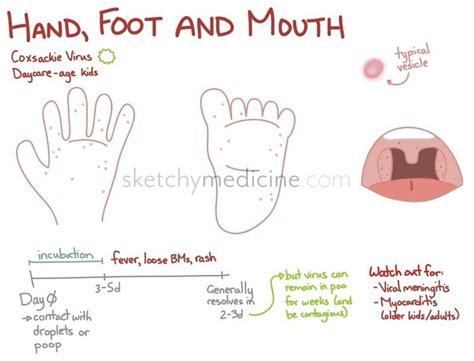 Hand Foot and mouth disease Diagram | Quizlet