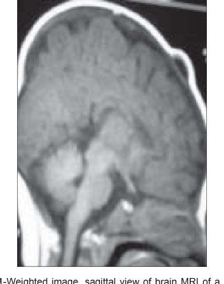 Figure 1 From Congenital Dermoid Cysts Of The Anterior Fontanel