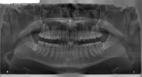 Got An X Ray For My Bottom Wisdom Teeth Today You Can Also See My Deviated Septum Rradiology