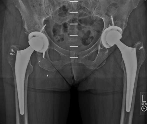 Postoperative Pelvic Radiograph After Bilateral Revision Total Hip