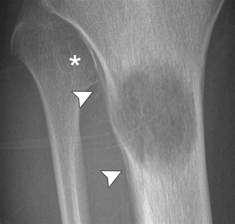 Radiography In The Initial Diagnosis Of Primary Bone Tumors Ajr