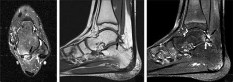 S Ndrome De Pinzamiento Posterior Del Tobillo Diagn Stico