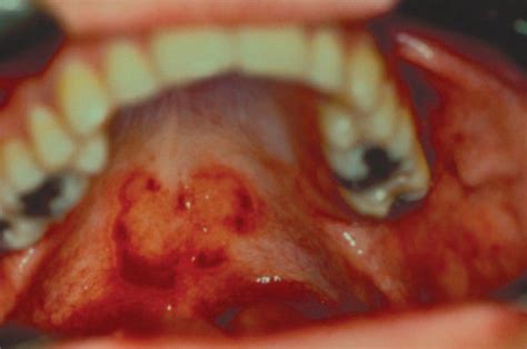 Ectopic Geographic Tongue Medizzy