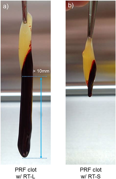 Frontiers Platelet Counts In Insoluble Platelet Rich Fibrin Clots A