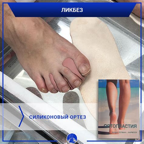 PodoAkademia ПодоАкадемия - Силиконовый ортез. . Самостоятельное ...