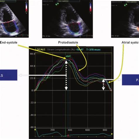 Measurement Of Peak Atrial Longitudinal Strain PALS At The End Of