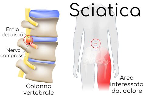 Sciatica Sciatalgia Sintomi Dolore Rimedi Dolore Gravidanza