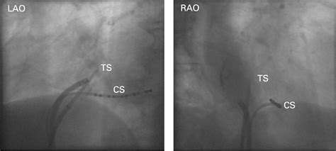 How To Perform A Transseptal Puncture Heart