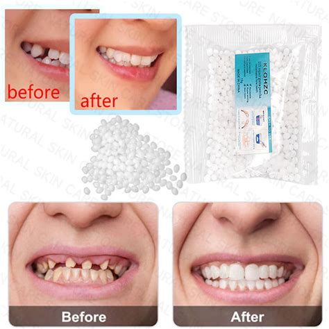 50g Temporary Tooth Repair Set False Teeth Solid Glue Tooth Filling