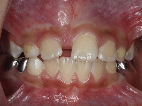 Supernumerary Teeth Affecting Maxillary Central Incisor