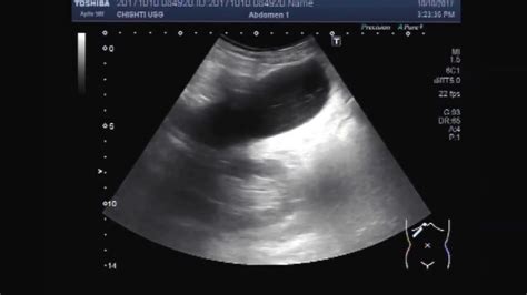 Ultrasound Video Showing Gallbladder Ascariasis And A Stone In The Neck