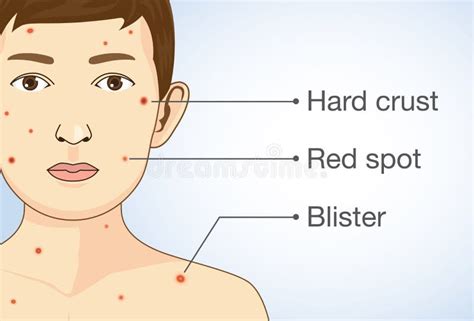 Varicella Zoster Virus Diagram