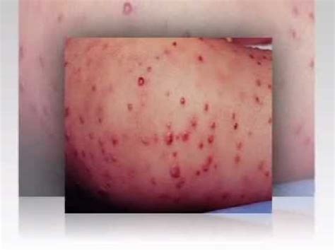 MRSA Staph Condition Infection Health Mrsa Bacterial Medical