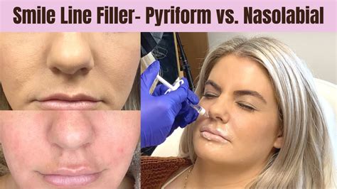 Pyriform Vs Nasolabial Filler To Reduce Smile Lines Lift Mid Face