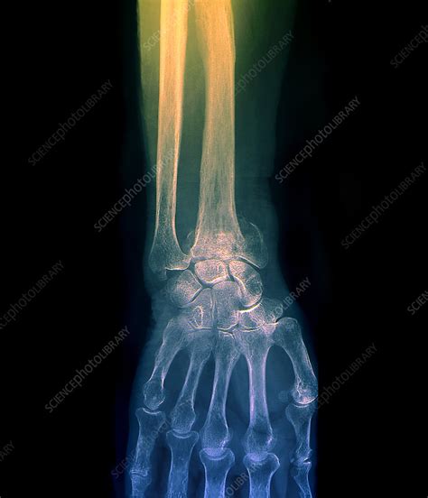 Colles Wrist Fracture X Ray Stock Image M3301644 Science Photo