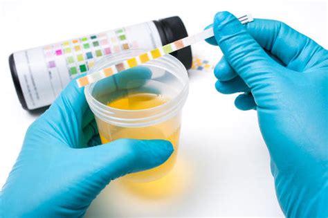 Protein In Urine Causes Symptoms And Treatment