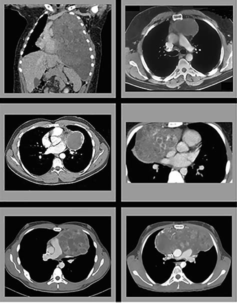 Mediastinal Germ Cell Tumors Surgical Oncology Clinics