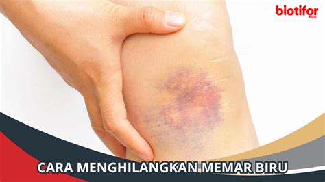 menghilangkan memar biru mudah  cepat biotifor
