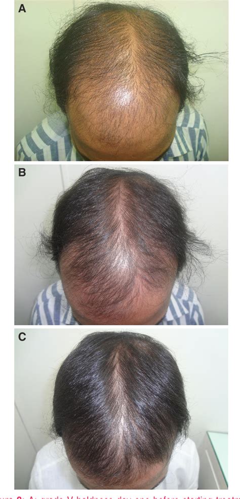 Figure 2 From Controlled Clinical Trial For Evaluation Of Hair Growth