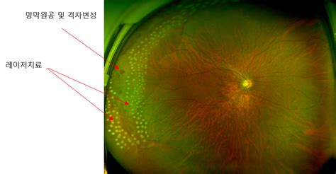 위험한 안질환 망막박리 환자제일주의 명지병원