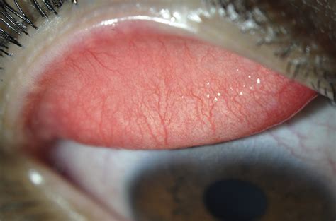 Figure 1 From Severe Vernal Keratoconjunctivitis Successfully Treated With Subcutaneous