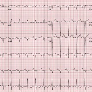 Electrocardiogram Revealing Sinus Tachycardia Previously Noted