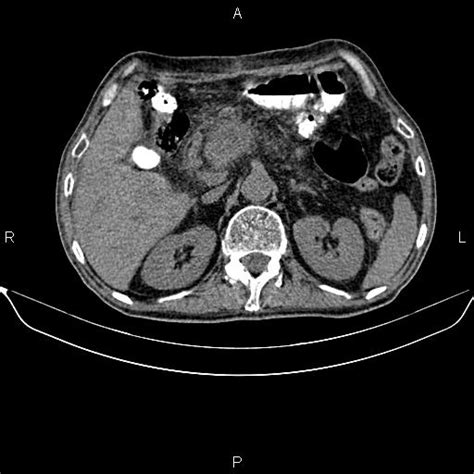 Pancreatic Cancer Image