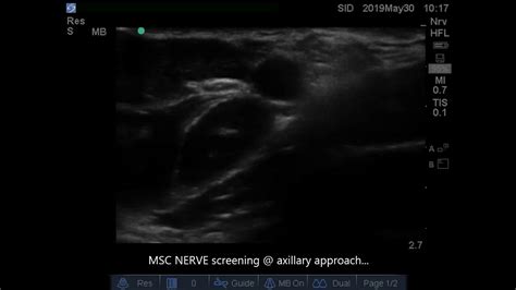 Ultrasound Guided Screening Of Musculocutaneous Nerve Axillary Approach Youtube