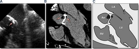 Imaging Of Prosthetic Heart Valve Dysfunction Complementary Diagnostic