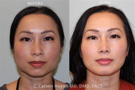 V Line Jawline Surgery Case 2165 Radiance Surgery And Aesthetic Medicine