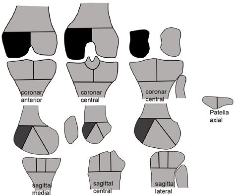 Figure 2 from Correlation of bone bruise pattern of the knee joint with ...