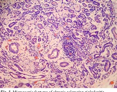 Figure 1 From Chronic Sclerosing Sialadenitis Küttner Tumor In The