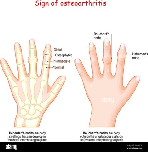 Osteoarthritis Flashcards Quizlet