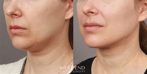 Renuvion Washington Dc Neck And Chin Skin Tightening